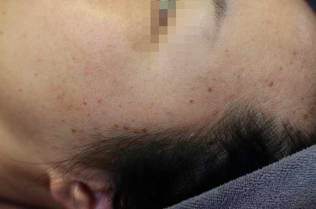 	제주편평사마귀 치료 전 이마 헤어라인 병변 사진