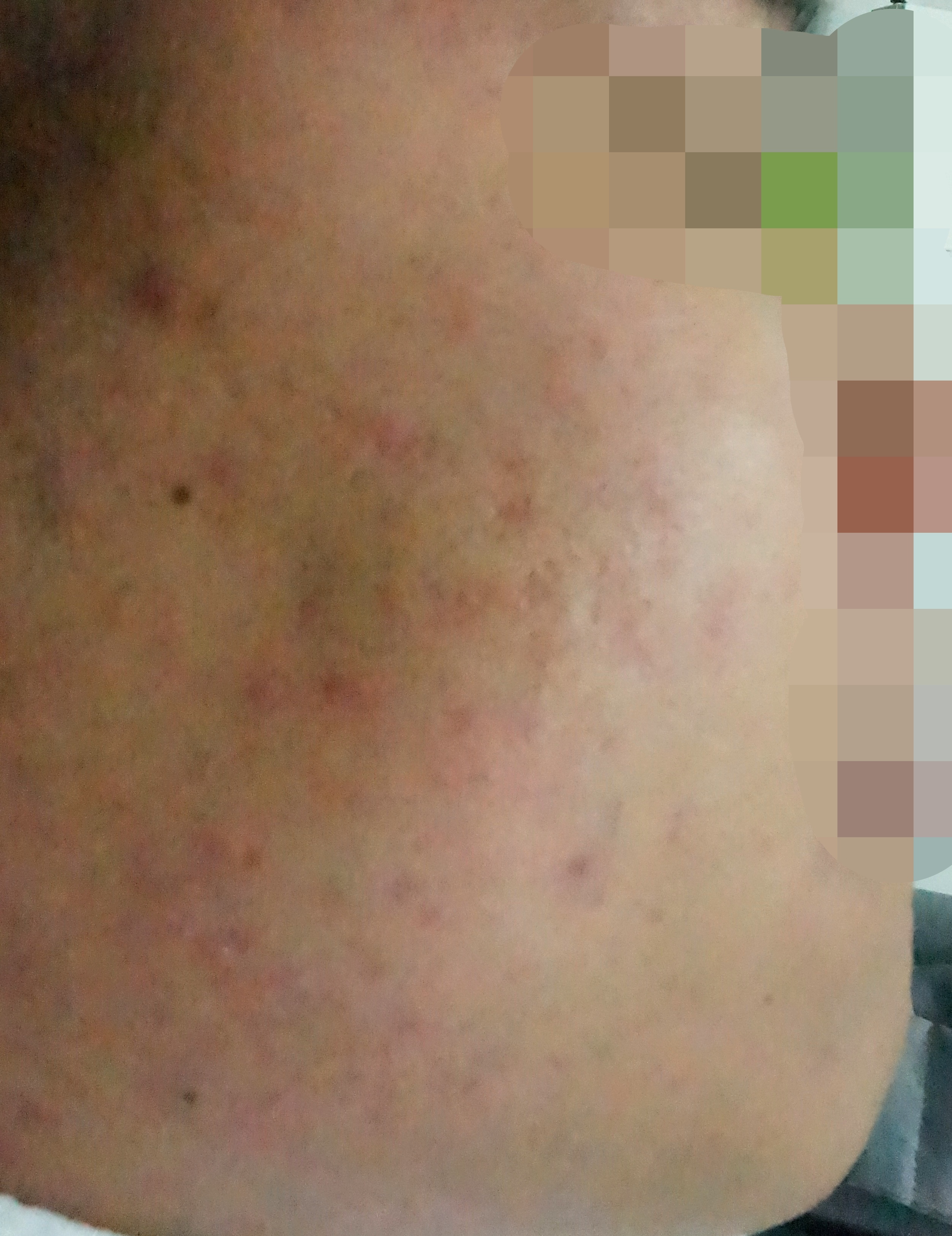 여드름 한방 치료 후 깨끗하게 개선된 볼 피부 변화 및 흉터 완화 상태