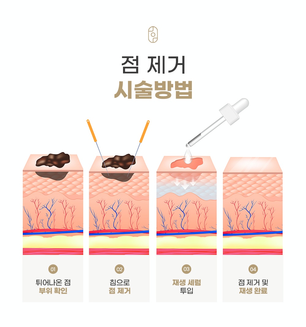 침 및 재생 세럼을 활용한 4단계 점 제거 시술 방법 일러스트