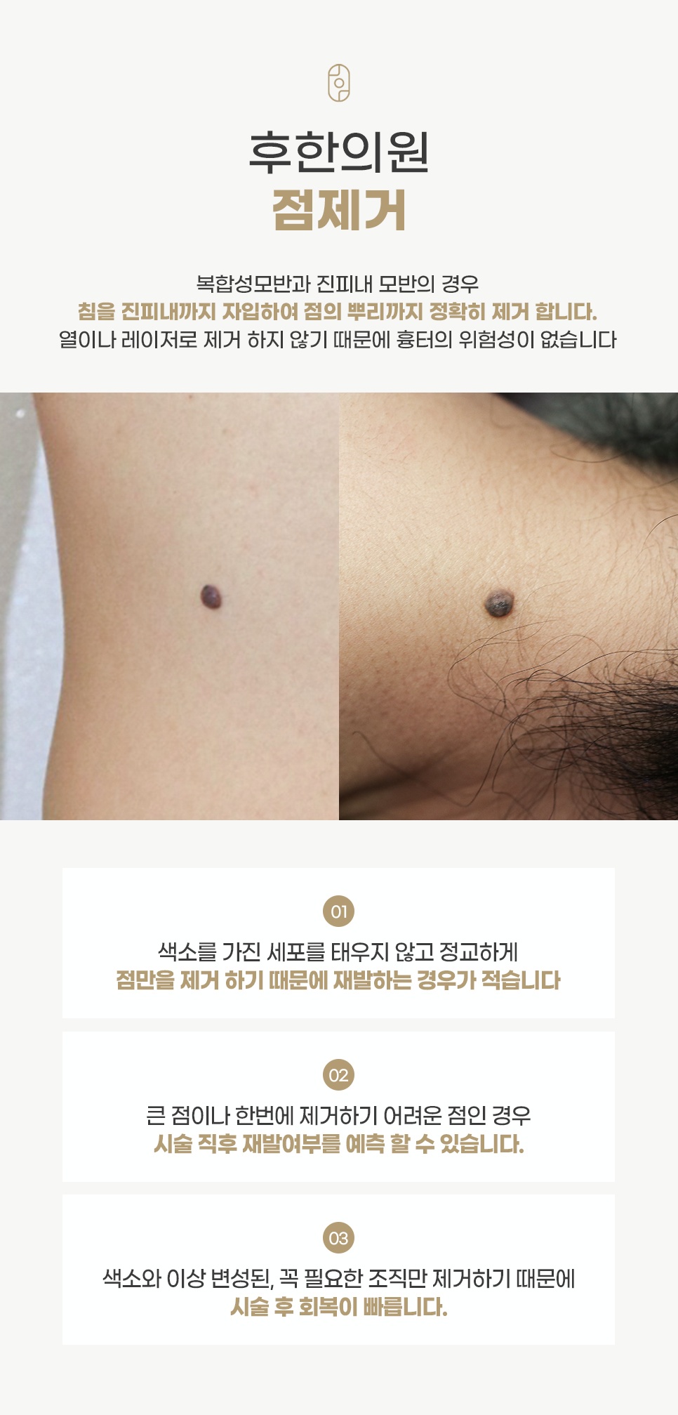 복합성모반 및 진피내 모반 침 제거 특징 및 전후 사례 안내