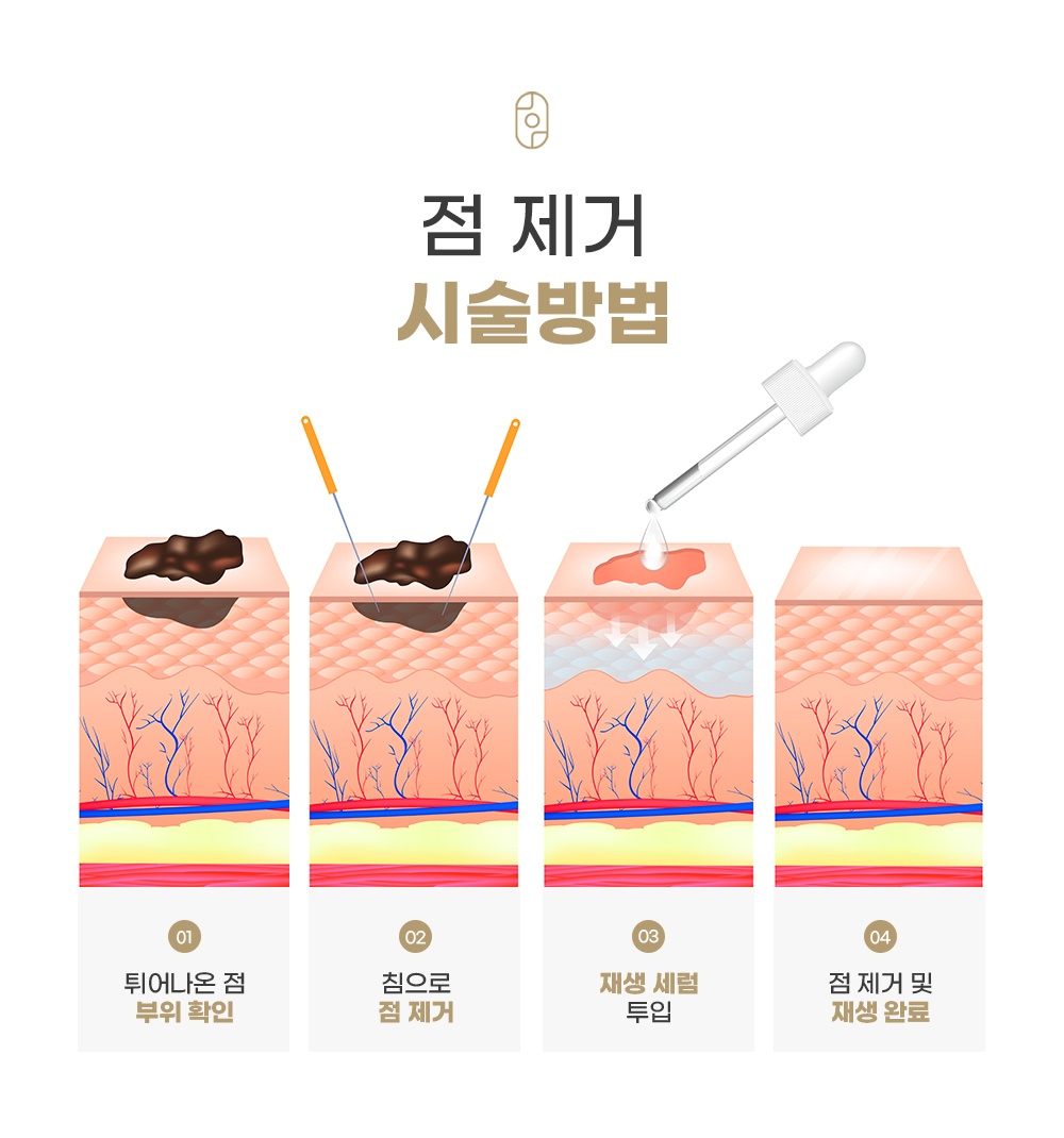 튀어나온 점 부위 확인부터 침 제거, 재생 세럼 투입, 재생 완료까지 보여주는 시술방법 단면도