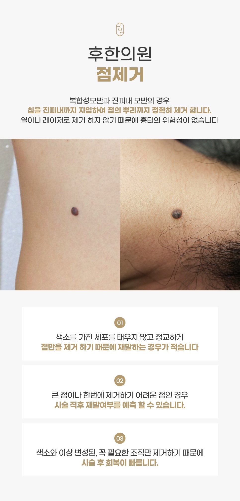침을 진피내까지 자입해 점의 뿌리까지 제거하는 후한의원 점제거와 복합성모반·진피내 모반 사진