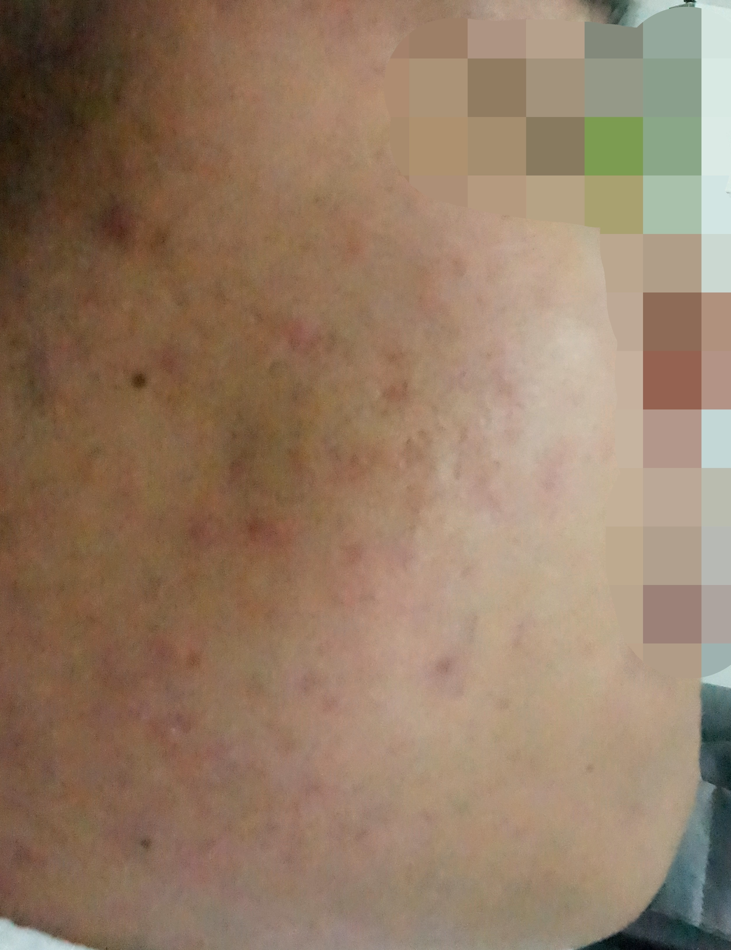 어깨와 등 위쪽에 붉은 자국이 흩어진 등여드름 피부 사진