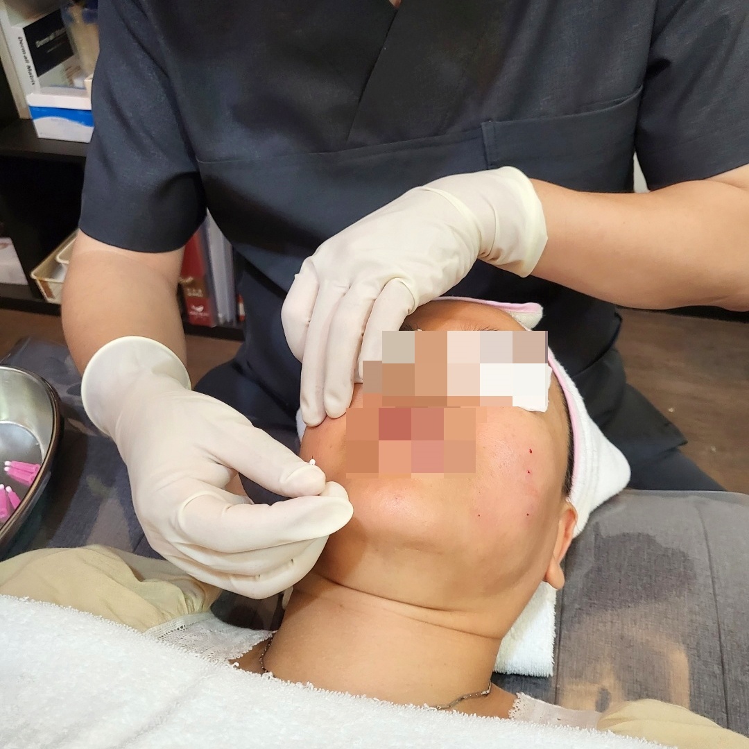 장갑 낀 손으로 볼 부위에 침 시술을 놓는 원장의 여드름 치료 모습