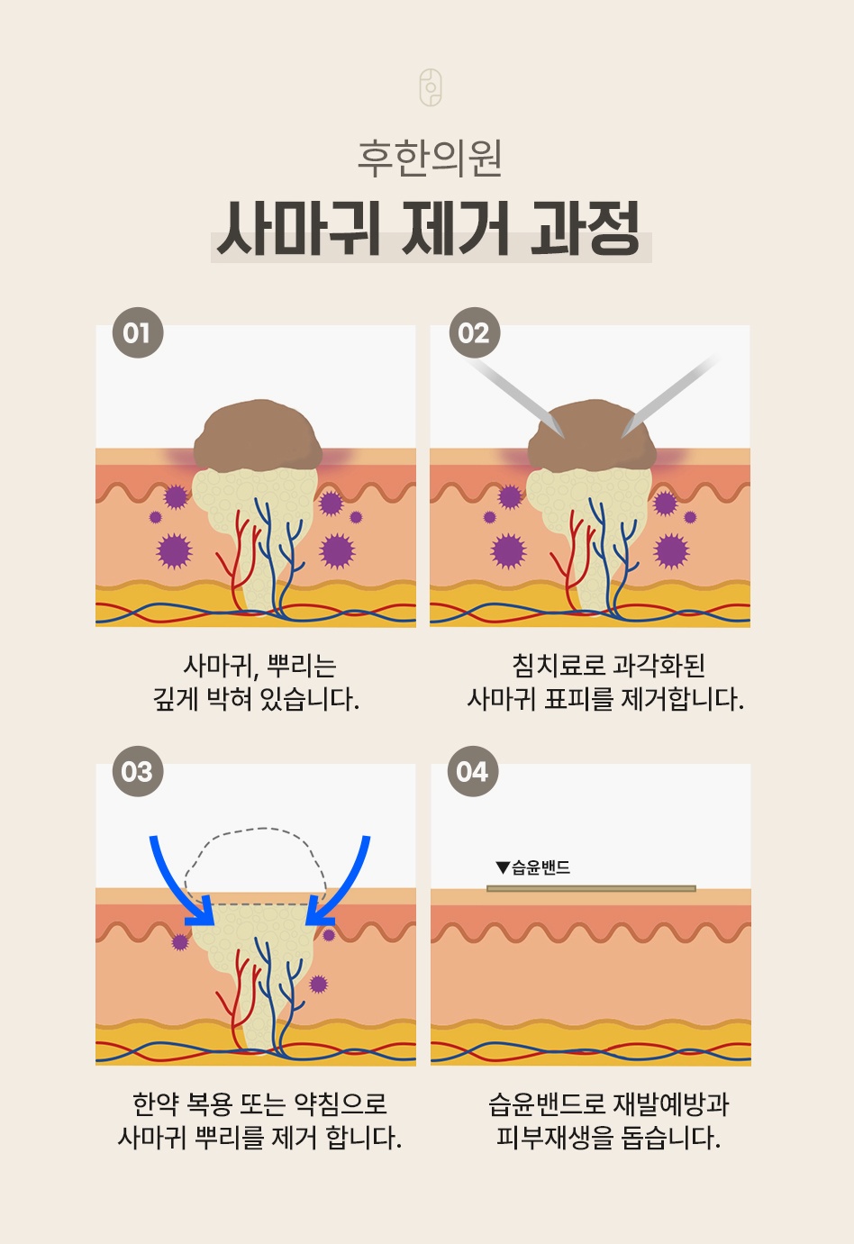 깊이 박힌 뿌리를 침 치료, 한약·약침, 습윤밴드 순으로 제거하는 사마귀 제거 과정 4단계