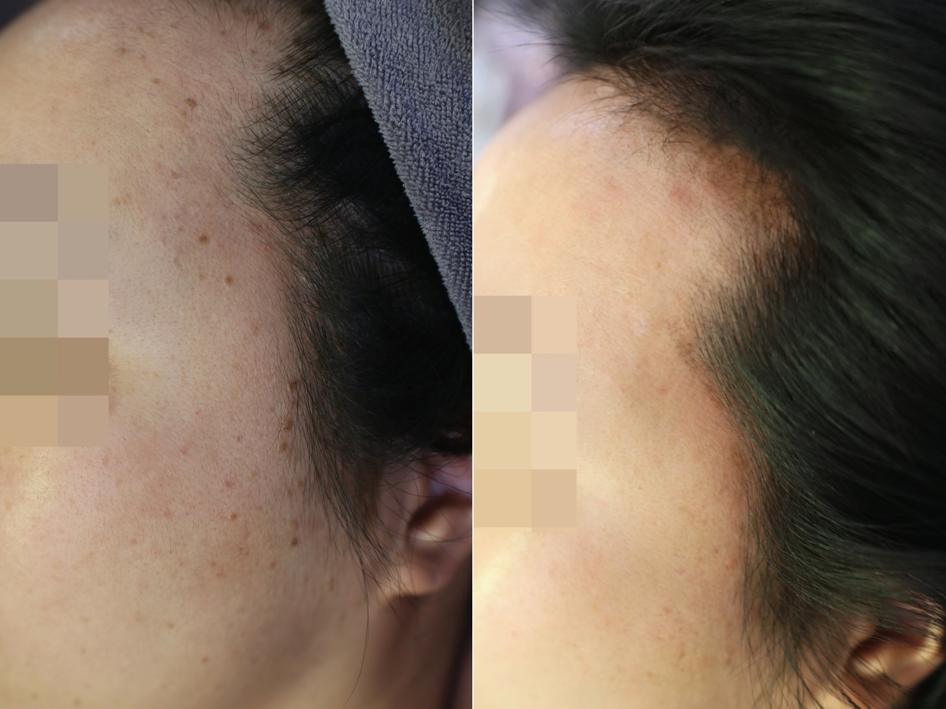 제주 편평사마귀 치료 전후